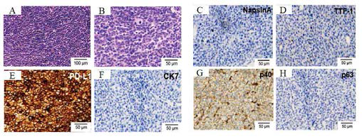 종양조직의 면역조직화학염색 분석 A. H&E 염색(저배율) B. H&E 염색(고배율) C. Napsin A, D. TTF-1, E. PD-L1, F. CK7, G. p40, H. p63