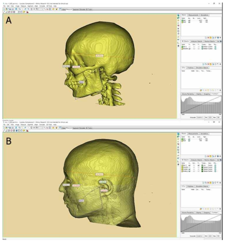 3차원 재건한 영상에서 머리뼈와 얼굴, 바깥귀를 컴퓨터프로그램으로 계측한 예. (A) 3차원으로 재건한 머리뼈 영상에서 계측한 예 (B) 3차원으로 재건한 얼굴 영상과 머리뼈 영상을 중복시켜 바깥귀의 크기와 위치를 계측한 예