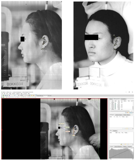 바깥귀의 2차원 영상을 컴퓨터프로그램으로 계측한 사진. (A) 가쪽 사진에서의 표지점, (B) 45도 사진에서의 표지점, (C) 표지점을 이용하여 컴퓨터프로그램인 Mimics로 실제 계측한 사진