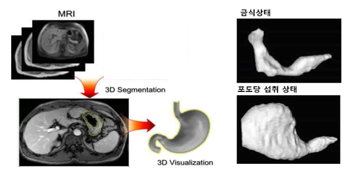 MRI 영상추출 기반 3D 모델링 방법(왼쪽)과 실제 MRI에서 얻은 위장의 3D 모델 (오른쪽)