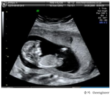 Foetal ultrasound image