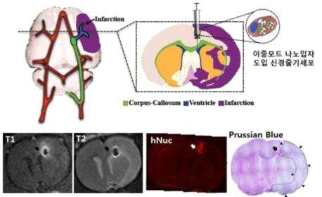 MRI T1/T2 영상에서 모두 조영효과가 뛰어난 이중모드 나노입자를 도입한 인간 신경전구세포를 뇌졸중 동물모델에 이식하여 생체 내 생착 및 이주를 뇌 MRI 검사를 통하여 추적