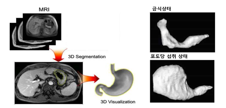 MRI 영상추출 기반 3D 모델링 방법(왼쪽)과 실제 MRI에서 얻은 위장의 3D 모델 (오른쪽)