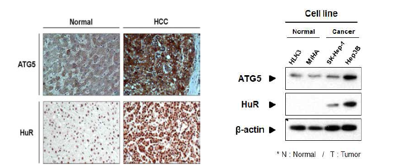 간암에서의 HuR 과 ATG5 발현의 정비례적 상관관계