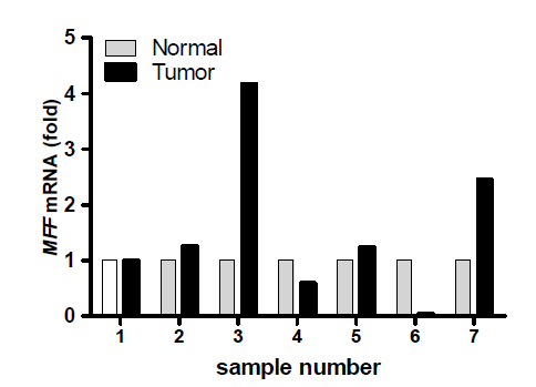 간암조직에서의 MFF mRNA발현