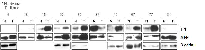 간암 조직에서의 T-1/MFF　발현 확인