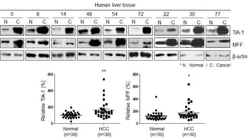 간암 조직에서의 TIA-1과 MFF 단백질의 발현변화 검증