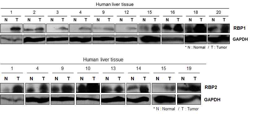 간암 조직을 이용한 후보 RNA 결합 단백질의 발현 차이 분석