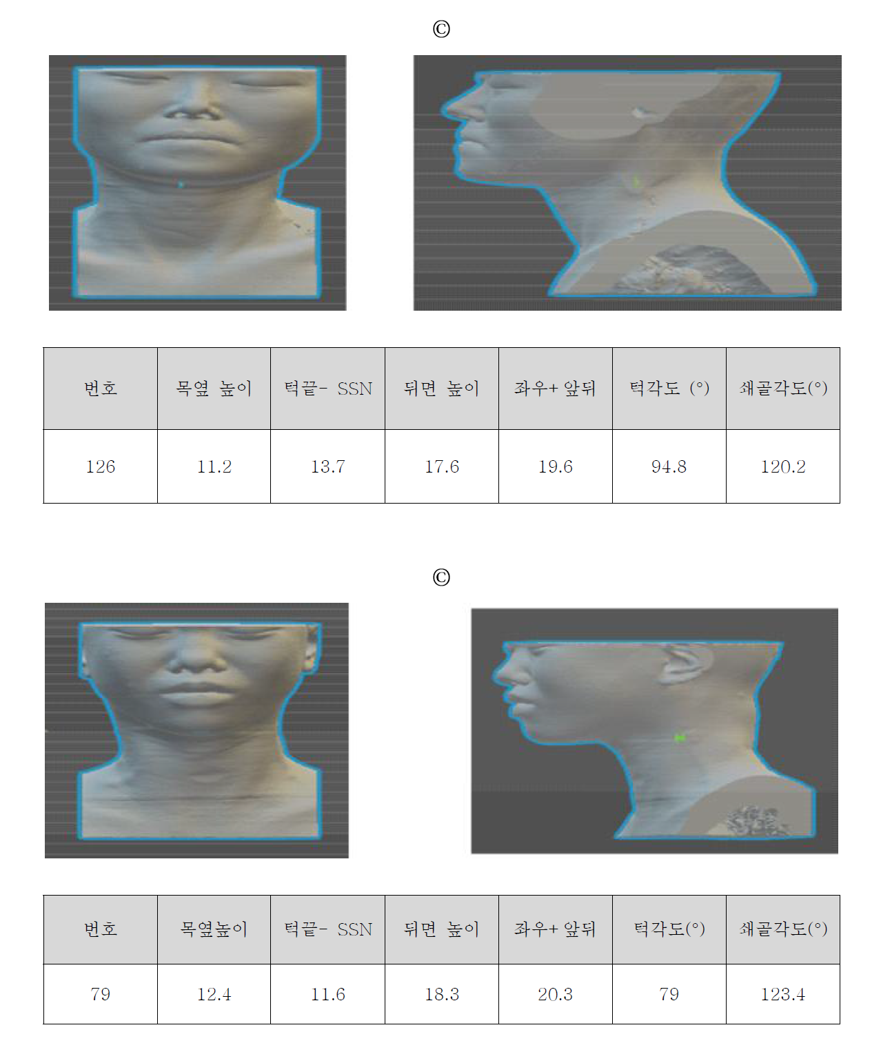 경추보호대 제작을 위한 모델 선정 (c)목이 길고 가는 모델