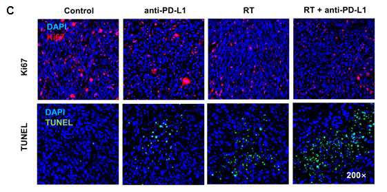 종양세포 증식 (red) 및 사멸 (apoptosis)