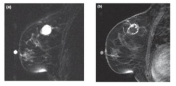 삼중음성 유방암을 MRI로 관찰한 예. (A) T2-강조 MR 영상. (B) T1-강조 MR 영상.