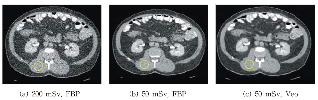 GE Healthcare 사의 복부 CT 복원 영상