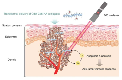 Schematic illustration for the photodynamic therapy of melanoma skin cancers after transdermal delivery of carbon dot – chlorin e6 – hyaluronate (Cdot-Ce6-HA) conjugate