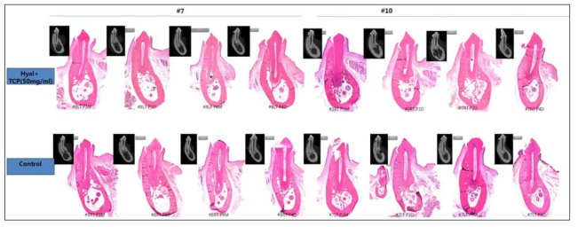TCP/Hyaluronic acid가 치주 조직 재생에 미치는 효과 : dog의 buccal dehiscence defect에 TCP particle (50mg/ml) 과Hyaluronic acid의 혼합물이 조직 재생에 미치는 효과를 분석함