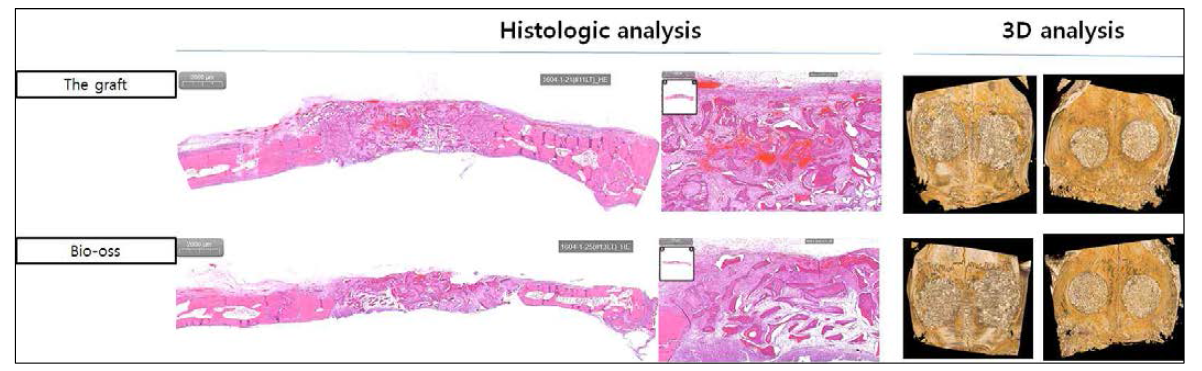 The Graft의 골 재생에 미치는 영향을 확인하기 위하여 수입제품인 Bio-Oss와 비교 분석하였음. 3D 분석 결과에서 The Graft 골편의 이식 상태는 고른 밀도를 나타내며 조직학적 분석에서도 Bio-oss와 동등한 조직 반응을 보임