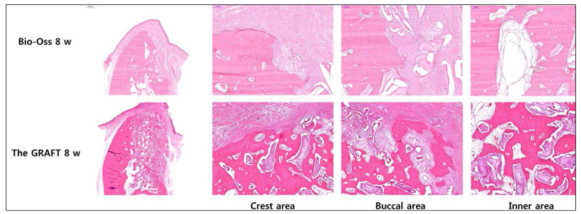 Bio-oss 그룹에 비교하여 The GRAFT군에서 보다 증대된 양의 치조골 재생을 확인할 수 있음. 골 재생의 가장 바깥부분에서 조직학적 소견의 차이점을 확인할 수 있음. Bio-oss군에서는 bone remodeling이 완성단계에 이른 것을 확인 할 수 있으나 The GRAFT군에서는 비교적 후기 단계임에도 불구하고 여전히 bone regenerative potential을 확인할 수 있다. crest area 와 buccal area의 바깥 경계 부분에서 Bio-oss군과는 다르게 immature bone의 new bone formation 증거를 확인할 수 있다. 이에 반해 Bio-oss군에서는 osteoclast들이 군집을 이루고 있는 소견을 쉽게 관찰할 수 있다. 이는 The GRAFT군에서 보다 증가된 골재생 면적이 확보될 수 있는 기전으로 제시될 수 있다