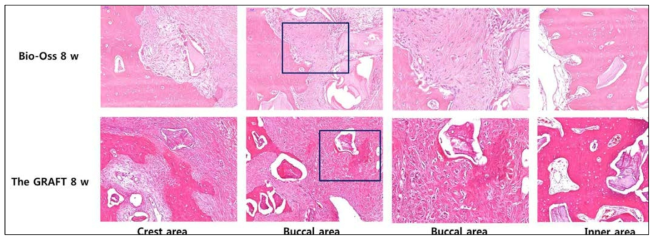 Bio-oss군의 골재생은 crest area와 buccal area 에서 osteoclast의 군집 이 관찰되는 등 8주에 완성단계에 도달하는 것 같다. 하지만, The GRAFT군에서는 8주의 비교적 후기 치유 단계임에도 불구하고 신생골 재생이 확인되는 등, active new bone formation이 여전히 유지되고 있는 것을 확인할 수 있다. The GRAFT는 새로운 골재생을 위한 공간의 생성 뿐 아니라 질적으로도 new bone formation process를 변화시킨다고 결론지을 수 있다. 임상적으로는 양적 그리고 질적으로 우수한 골재생 결과를 얻을 수 있다는 것을 보여줌