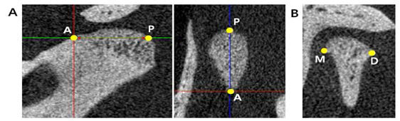 하악과두의 크기 계측 방법. A, 전후방적 길이. B, 폭경