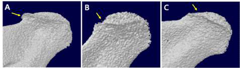 하악과두에 발생한 골관절염. A, Osteophyte. B, Bone erosion. C, Flattening