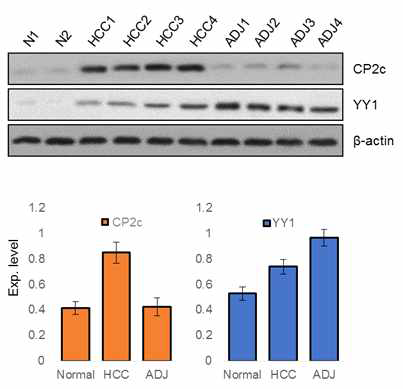 HCC 간암환자 조직에서 CP2c 및 YY1 단백질 발현 양상