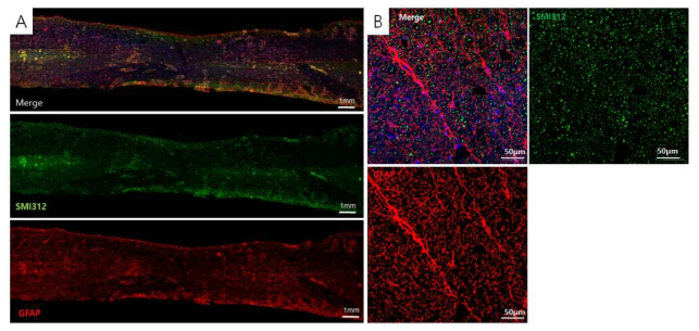척수 좌상 12주 후 손상된 척수 주변의 면역형광염색 사진. (A) 신경세포(중앙) 및 성상세포(하단) 염색 결과 (B는 확대 사진)
