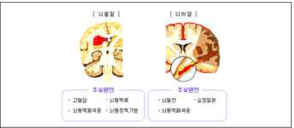 뇌졸중의 종류 및 병리학적 구분