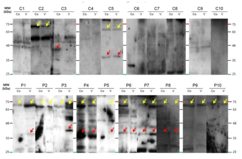 양측성 돌발성 난청 환자의 혈장과 마우스 내이 조직과의 western blot. 정상군(위)과 비교하였을 때 환자군(아래)의 실험에서 68kDa 및 38kDa 부위 일관적 band가 발현됨