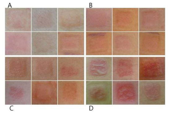피부자극 평가기준 및 인체패치 시험에 의한 피부자극 반응의 대표사진 (A: 0.5(±) 등급, B: 1(+) 등급 , C: 2(++)등급, D: 3(+++)등급)