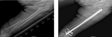 좌측 대퇴골 원위부의 골절 및 수술 후 방사선 사진