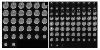 Multiband(MB) EPI 적용 전 (좌), 후 (우) 획득 whole brain MRI