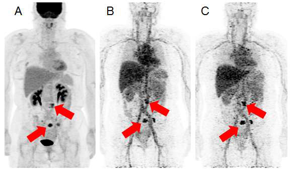 유방암의 18F-FDG PET (A)과 64Cu-DOTA-trastuzumab PET(B, C) 영상