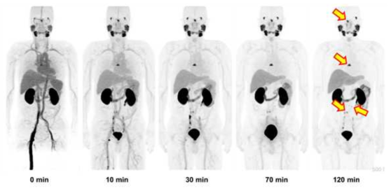 전립선암 환자에서 [F-18]Florastamin 투여 이후 시간에 따른 PET 영상 변화. 뼈전이가 있는 부위에 [F-18]Florastamin의 국소적 섭취가 관찰됨