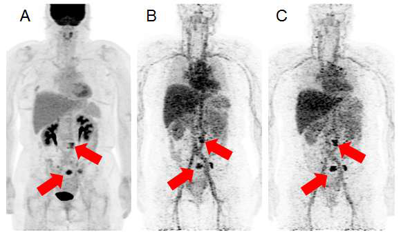 HER2 3+ 유방암환자에서의 뼈 전이 병변. 18F-FDG PET (A) 영상과 64Cu-DOTA-trastuzumab PET(B, C) 영상
