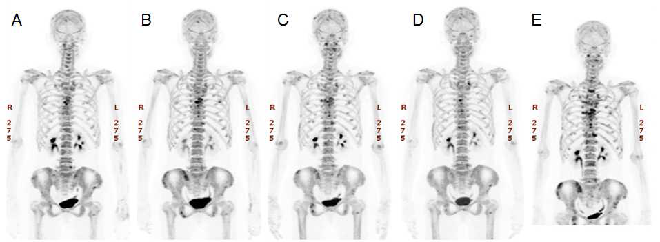 뼈 전이가 있는 유방암 환자에서 223Ra-dichloride 투여 후 시간에 따른 18F-NaF PET/CT 영상변화. (A) 투여전. (B) 1차 투여후 4주. (C) 2차 투여후 4주. (D) 3차 투여후 4주. (E) 3차 투여후 8주