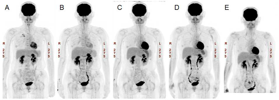 뼈 전이가 있는 유방암 환자에서 223Ra-dichloride 투여 후 시간에 따른 18F-FDG PET/CT 영상변화. (A) 투여전. (B) 1차 투여후 4주. (C) 2차 투여후 4주. (D) 3차 투여후 4주. (E) 3차 투여후 8주