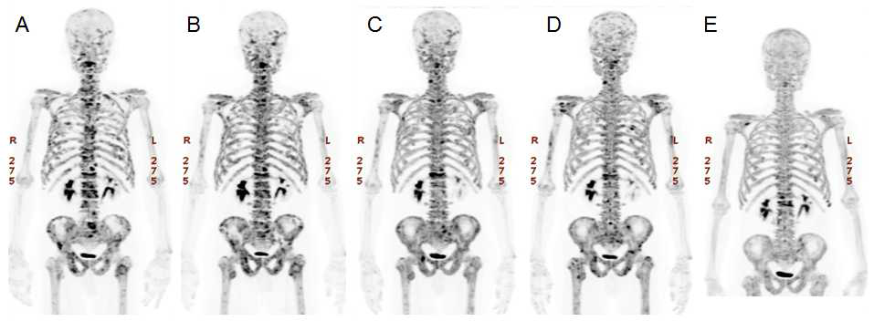 뼈 전이가 있는 거세저항성 전립선암 환자에서 223Ra-dichloride 투여 후 시간에 따른 18F-NaF PET/CT 영상변화. (A) 투여전. (B) 1차 투여후 4주. (C) 2차 투여후 4주. (D) 3차 투여후 4주. (E) 3차 투여후 8주