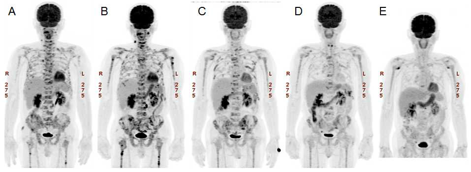 뼈 전이가 있는 거세저항성 전립선암 환자에서 223Ra-dichloride 투여 후 시간에 따른 18F-FDG PET/CT 영상변화. (A) 투여전. (B) 1차 투여후 4주. (C) 2차 투여후 4주. (D) 3차 투여후 4주. (E) 3차 투여후 8주