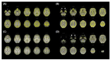 DMN 분석을 위하여 영상 전처리 결과. (A, C) T1 MRI 영상, (B, D) fMRI 영상