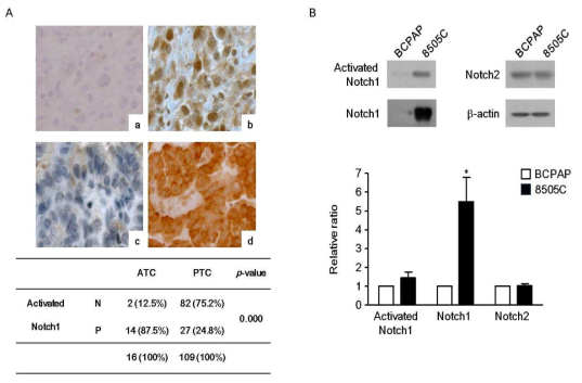 Expression of activated Notch1 in patient tissues and thyroid cancer cell lines