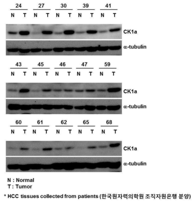 Western blot analysis. CK1α protein level is increased in tumor tissue (T) than the pairing adjacent non-tumor liver tissue (N). The biospecimens and data used in this study were provided by the Radiation Tissue Resources Bank of Korea Cancer Center Hospital