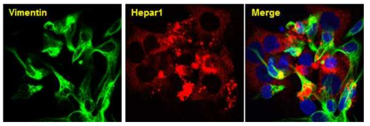 간암세포에서 Vimentin, Hepar1 의 발현