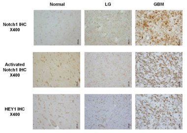 Immunohistochemical staining results for Notch 1 signaling pathway molecules in each group (Normal:non neoplastic brain tissue, LG: low grade glioma, GBM: glioblastoma), x 200 (original magnification)