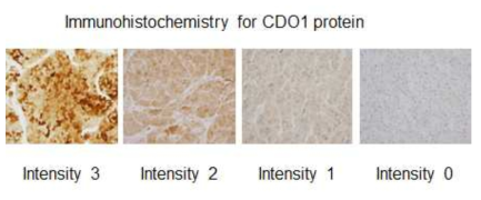 Examples of immunohistochemistry for CDO1 protein in HCC tissues. Tissues are graded by the intensity of staining of the protein