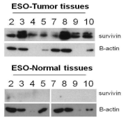 ESCC tissue에서의 survivin발현