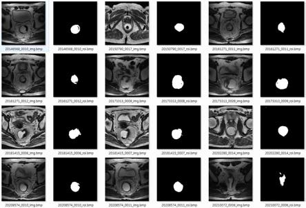 2D 영상을 이용한 딥러닝 기반의 rectum segmentation을 이용하여 segmentation 한 결과