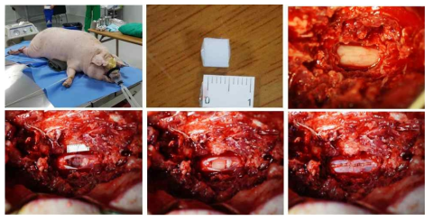 미니피그 척수완전절단모델 제작 및 5mm 길이의 미세구조 신경도관 이식 수술 장면