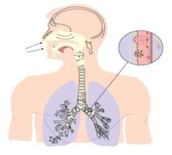 라돈 자핵종의 폐에 대한 알파방사능 피폭 모형 (Source : http://www.hse.gov.uk/radiation/ionising/radon.htm)