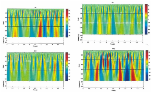 정상인, 알츠하이머, CJD, 타 퇴행성뇌질환 환자들의 EEG signals의 도식화 (Morabito et al., 2017)