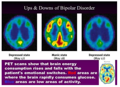양극성 정동장애 환자의 기분 삽화에 따른 뇌의 포도당 사용량