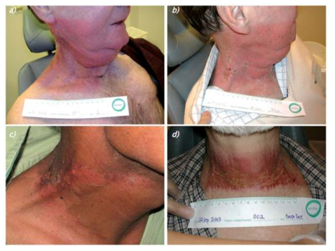 Radiotherapy-related skin reactions. a) Erythema, b, c) dry desquamation, and d) moist desquamation. (https://cancerworld.net/e-grandround/radiotherapy-related-skin-reactions/)
